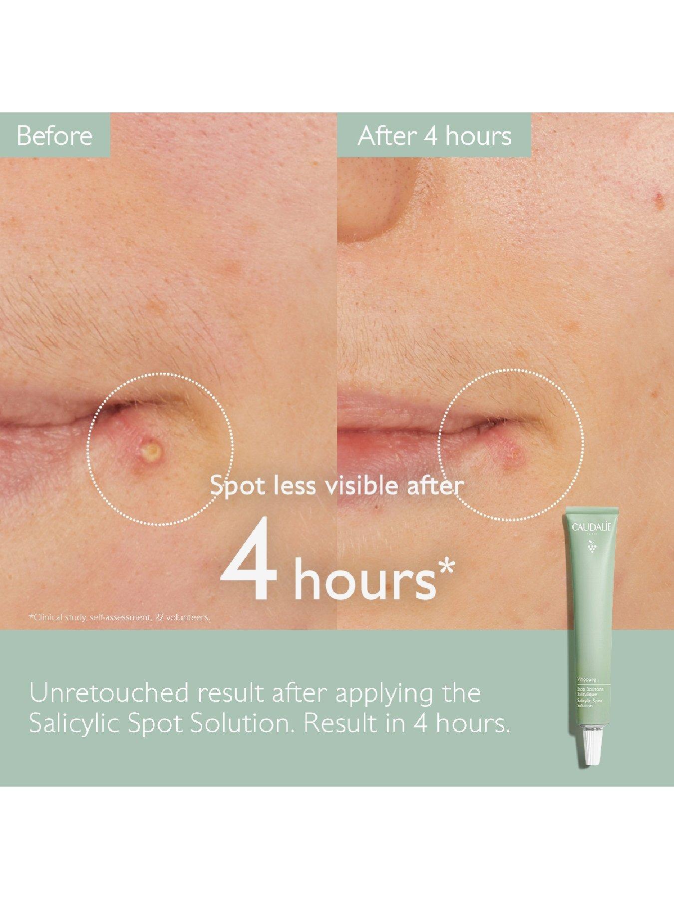  image of caudalie-vinopure-salicylic-spot-solution-15ml
