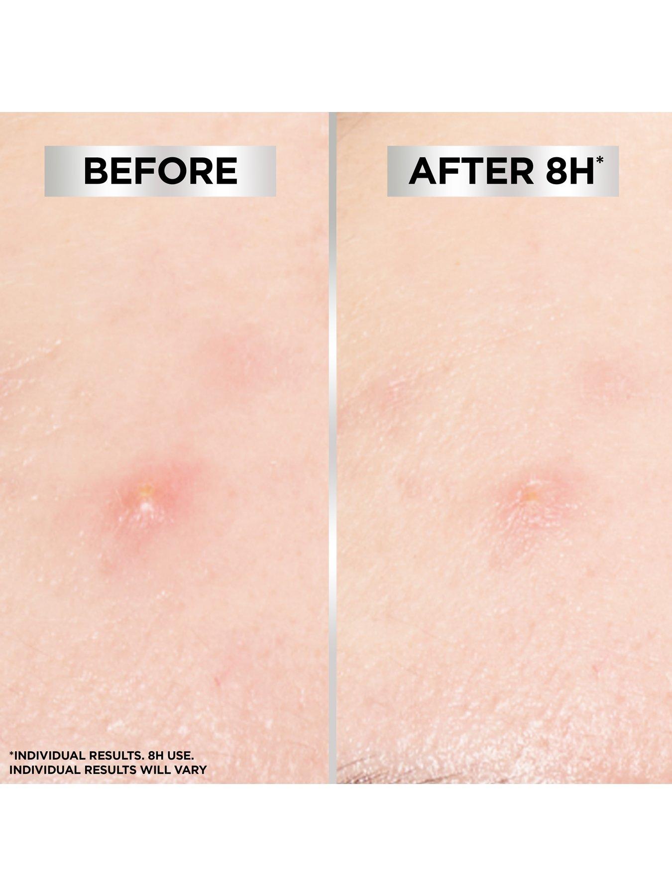 Image 5 of 7 of Garnier 8H Invisible Blemish Patches (44 Patches)