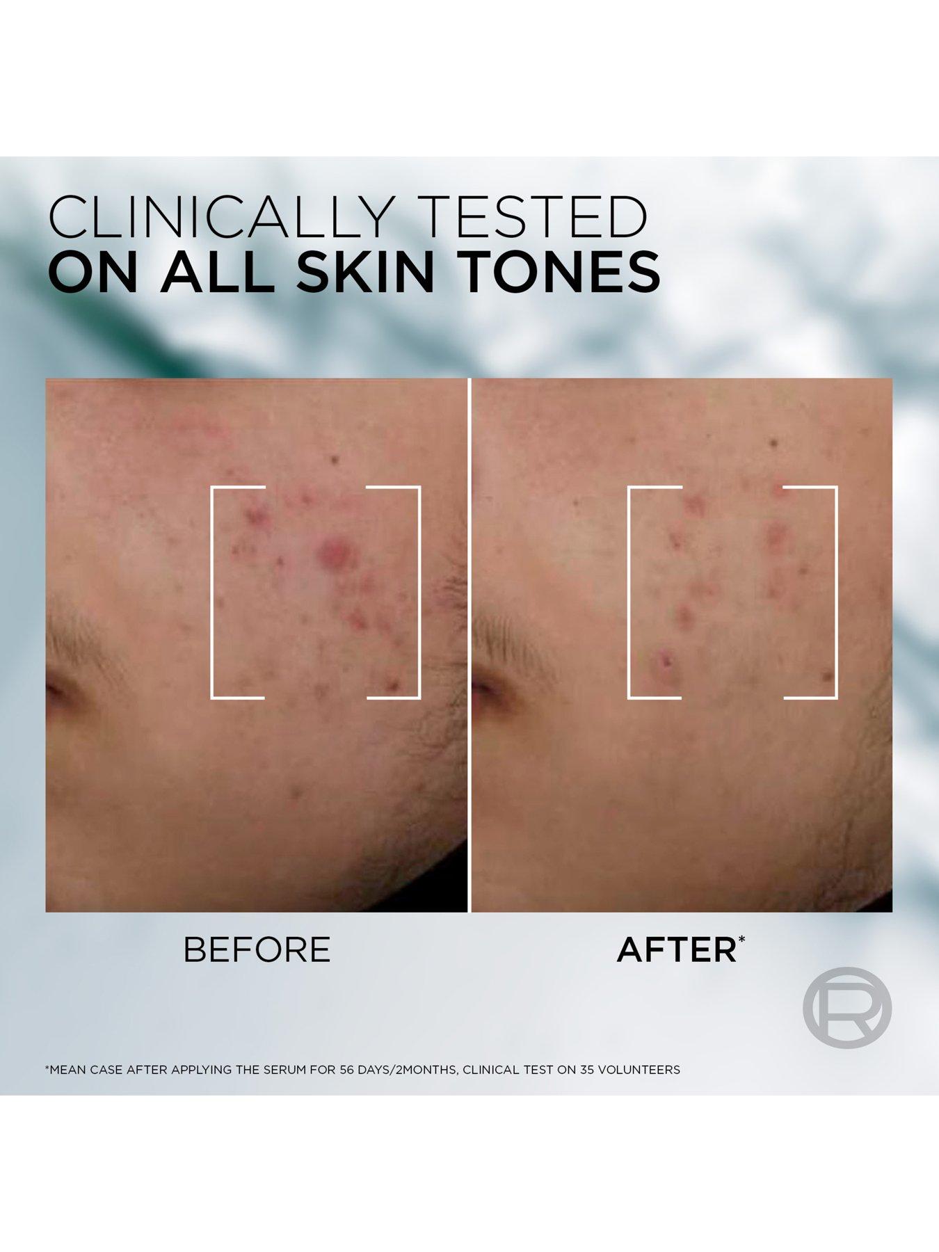 Image 3 of 7 of L'Oreal Paris Men Expert L'Oreal Men Expert Derma Control Anti-Blemish Serum with 3% Niacinamide + Salicylic acid 30ML